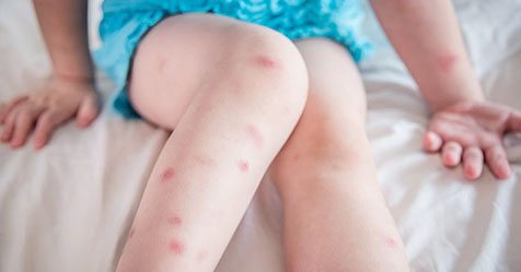Piqûres de punaises de lit sur les jambes d'un enfant
